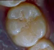 sealant preop1 med.webp
